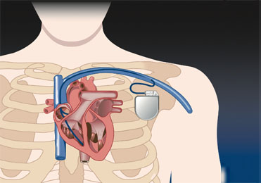 Cardiac Resynchronization Therapy